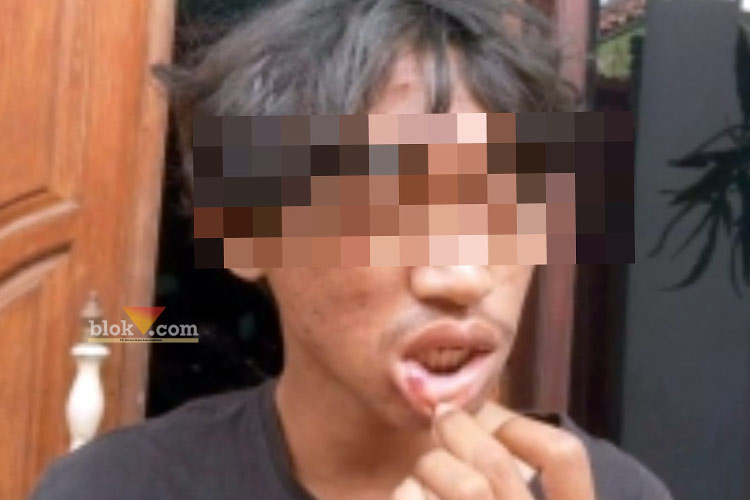 Korban pengeroyokan pemabuk tunjukkan bekas luka di bibir, Minggu (30/6/2026) (blok-a/Andik Agus)