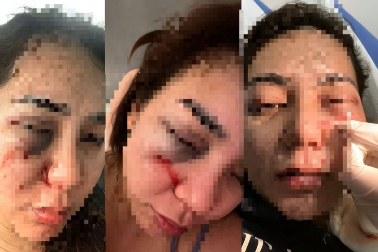 Diduga Dianiaya Pacarnya yang Seorang DJ, Perempuan di Malang Laporkan Kasus ke Polisi